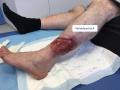 Tendon-Voussure8.png