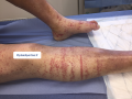 Purpura par fragilité capillaire4.png