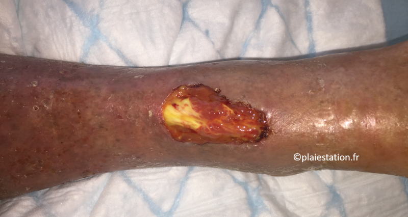 Fichier:Tendon1.png