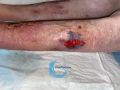 Dermatoporose43.jpg
