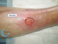 Nodule2.jpg