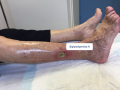 Tendon nécrotique humide33.png