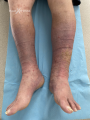 Dermiteocre50.png