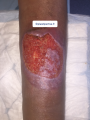 Epidermisation1.png