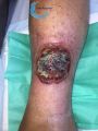 Pyoderma gangrenosum31.jpg