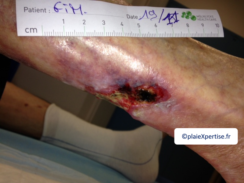 Fichier:Angiodermite typique32.png