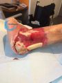 Tendon normal33.jpg