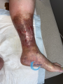 Dermiteocre57.png