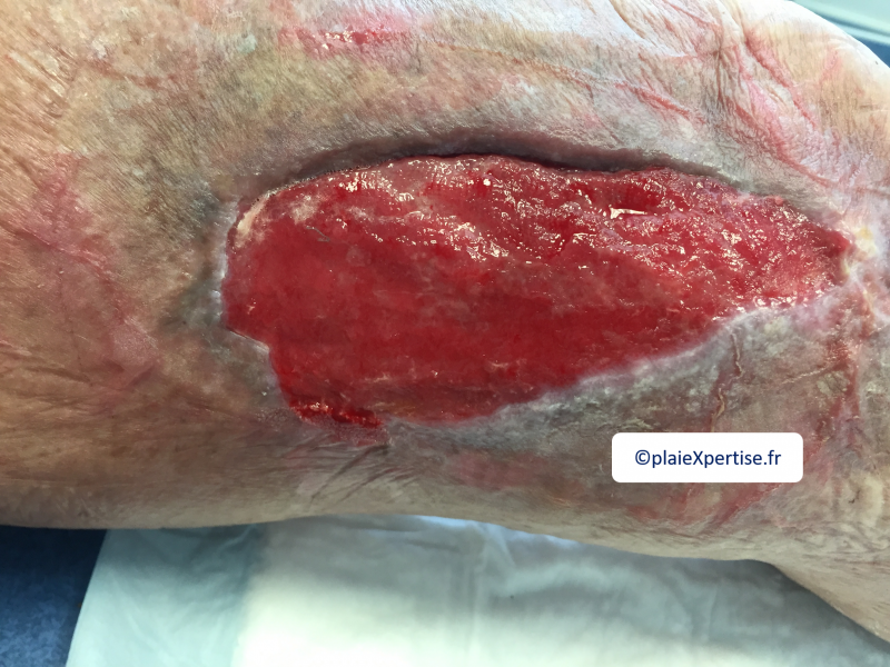 Fichier:Tissu de granulation normal13.png
