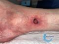 Angiodermite typique80.jpg
