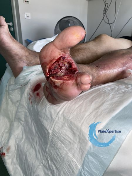 Fichier:Amputation59.jpg