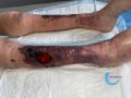 Dermatoporose49.jpg