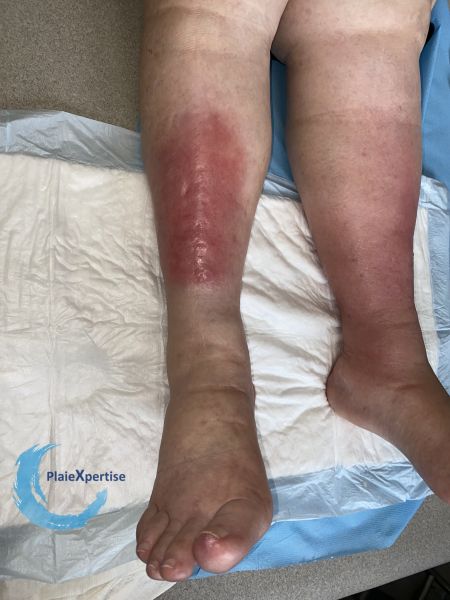 Fichier:Hypodermite chronique62.jpg