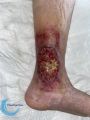 Ulcère veineux31.jpg