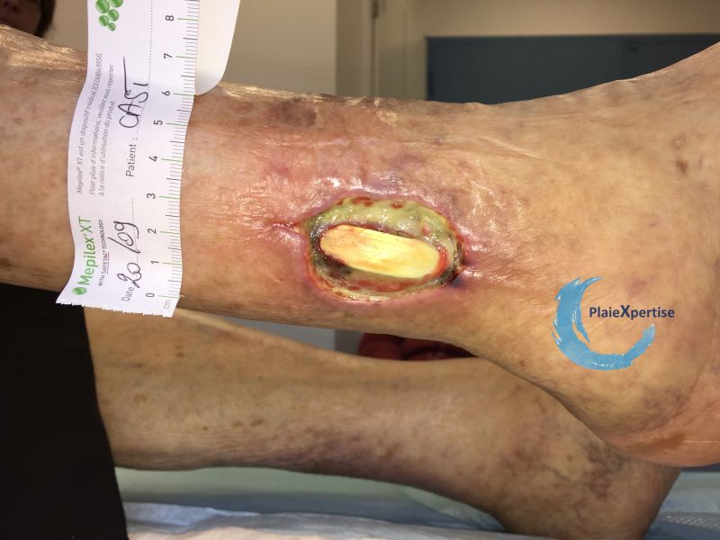 Fichier:Tendon normal32.jpg